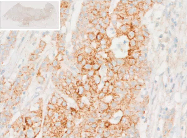 Immunohistochemical analysis reveals accumulation of L-Kynurenine within tumor cells of human colorectal cancer (CRC) tissue.