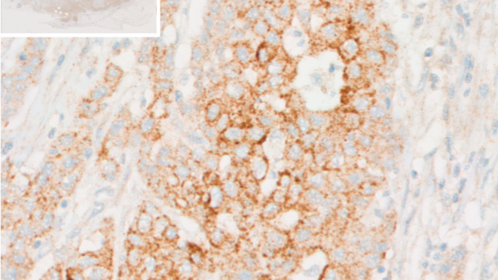 Using DiscoveryUltra™ platform (Ventana), a paraffin-embedded tissue section of CRC was subjected to antigen retrieval, and incubation with primary anti-KYN monoclonal antibody. Presence of Kynurenine was then evaluated through the use of a DAB conjugated secondary antibody. Image (x40 magnification) was acquired using Polaris Vectra (Perkin Elmer) automated slide scanner.